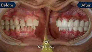 Mera's Ultimate Hollywood Smile Transformation | Kristal Clinic