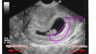 Baby Girl At 8 Weeks.