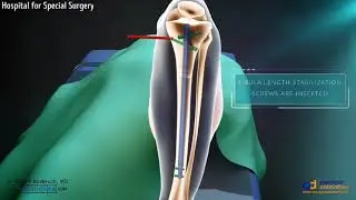 ।। Leg bone surgery ।।#conceptstudy #surgeryresults  #bones #doctor #bonesurgery #surgeryvideo