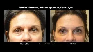 WATCH Botox Injection with Before and After. Board Certified Dermatologist in Stamford, CT
