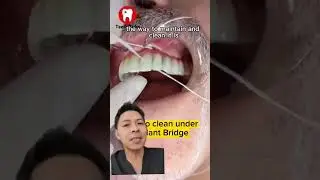 Implant Cleaning with Superfloss