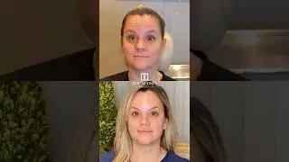 Ботокс + филлер для губ до и после