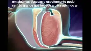 Roncos e apn&eacute;ia