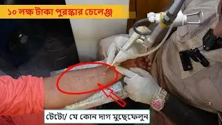 স্কিনের অবাঞ্চিত দাগ নিয়ে ভাবার দিন শেষ, এখন বাংলাদেশে আধুনিক মেশিন দিয়ে শরীরের যেকোন দাগ মুছে ফেলুন