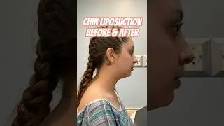 Mariah&rsquo;s Chin Lipo Results ✨ Double Chin Gone at Adonis Plastic Surgery (Torrance, CA)