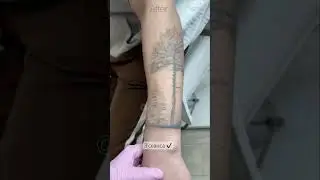 Правильное лазерное удаление тату ✔️ #tattooremove #лазерноеудалениетату