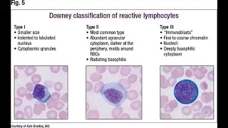 Downey classification of reactive lymphocytes or Downey cells; Type 1, Type 2, Type 3 Characteristic