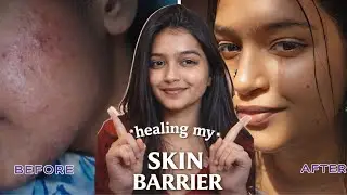  I Cleared My * Pimples & acne marks* in just 15 Days (No Filter)🥹🌸🌷