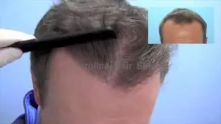 Carolina Hair Surgery - FUE Hair Transplant Results