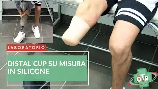 OTR Ortopedia - LABORATORIO - Distal Cup su misura e Prova della Protesi