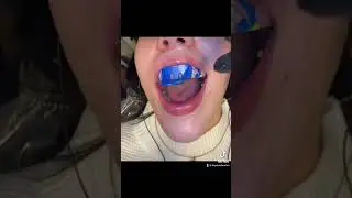 Taking impressions for veneers! #satisfying