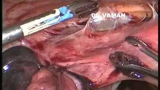 ectopic adherent to lscs scar lnear incision with tubal consurvation voice