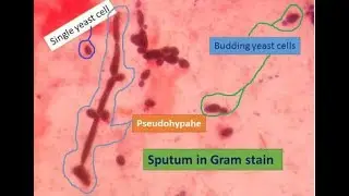 Gram positive Yeast cells, budding yeasts and pseudohyphae in Gram staining of culture