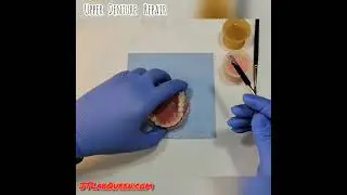 Full Upper Denture Repair