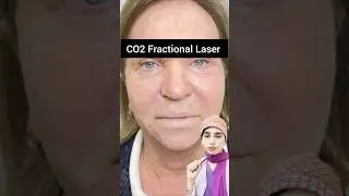 Do you want to look young 🥹#co2laser #rejuvination #wrinklereduction