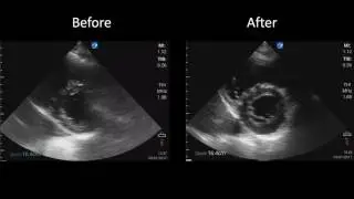 Massive PE - Pre and Post IV fibrinolysis EM - POCUS Echo