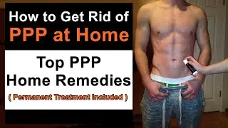 How to Get Rid of PPP at Home? - Top PPP Home Remedies (Permanent Treatment Included)