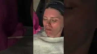 Chemical Peel For Skin Texture