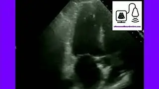 Side Lobe Artifact