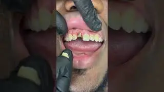 Single front tooth implant ❤️ Now you see it , now you don't!