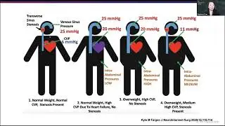 The Pathophysiology of IIH as Created by Dr  Kyle Fargen