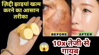 आलू से झाइयां हटाने का कमाल का तरीका | Reduce Melasma, Pigmentation, Discolouration, Blackspots