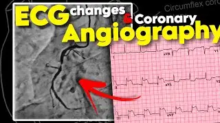 ECG changes in Myocardial Infarction and Coronary Angiography | Daily Cardiology