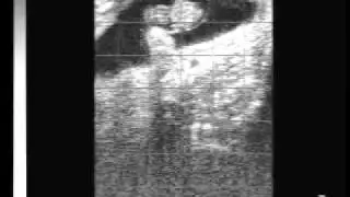 Bovine pregnancy 40 days with Easi-Scan ultrasound.wmv
