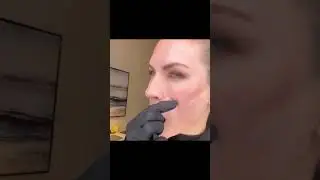 How to dissolve dermal fillers?