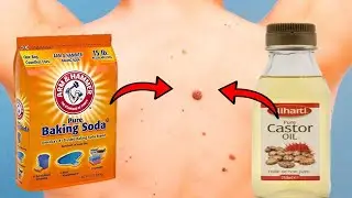 Get Rid of Warts, Moles, and Skin Tags with Castor Oil and Baking Soda