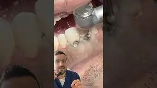 CARIE de l&rsquo;EXTR&Ecirc;ME : comment sauver des dents ab&icirc;m&eacute;s