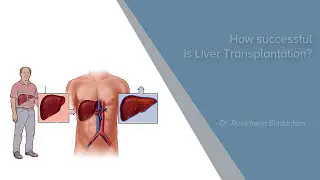 How Successful Is Liver Transplantation? | Liver Transplantation | Manipal Hospitals