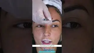 Botox e rugas na testa
