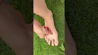Acupuntura Automasaje - H&iacute;gado 3 Tai Chong