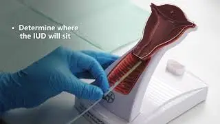 IUD insertion and risks