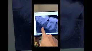 THIS 12-year old needed a root canal on tooth #31. #endodontist #dentist #rootcanal #dentalclinic