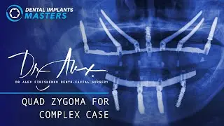 Complex Full Arch Cases | Plan and Recap - Episode 4