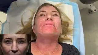 Morpheus8 Facial Rejuvenation is The Game Changer in Skin Tightening!