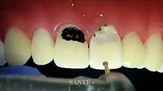 dental filling procedure, white tooth color