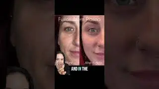 Fusion Plasma Pro results ✨ #beforeandafter #skincare #beauty #plasma #fusionplasma #skincare