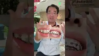 Lightforce v Regular Brace. What&rsquo;s the difference? #orthodontist #braces #lightforce