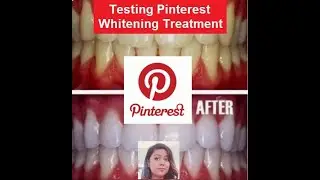 Testing Pinterest Homemade Whitening Treatment for Teeth | Melissa Athalia