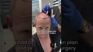 Allan's Hair Transplant Journey at Smile