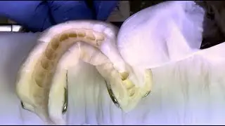 Abdruck ausgie&szlig;en Kieferorthop&auml;die Pouring Orthodontic Impressions Diagnostik-Modelle Study Models