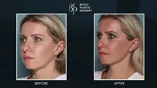 Lift and Define Your Face Without Incisions With the Xact&trade; Device