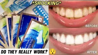 *INSANE* Urgent Teeth Whitening Strips | Teeth whitening at home