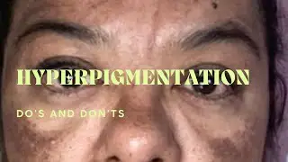 Hyperpigmentation: Treatment and prevention.