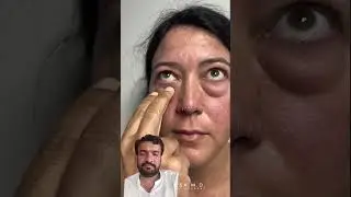 eye lower bag removals. #makeup #eyebagsurgery #beauty #skincare #makeupartist #usa
