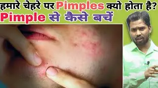 Why do we have pimples on our face? || How to avoid pimples #khansir #khangs #khansirpatna