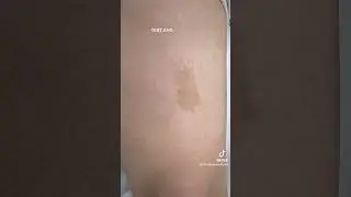 Cafe Au Lait Birthmark Removal #birthmarkremoval